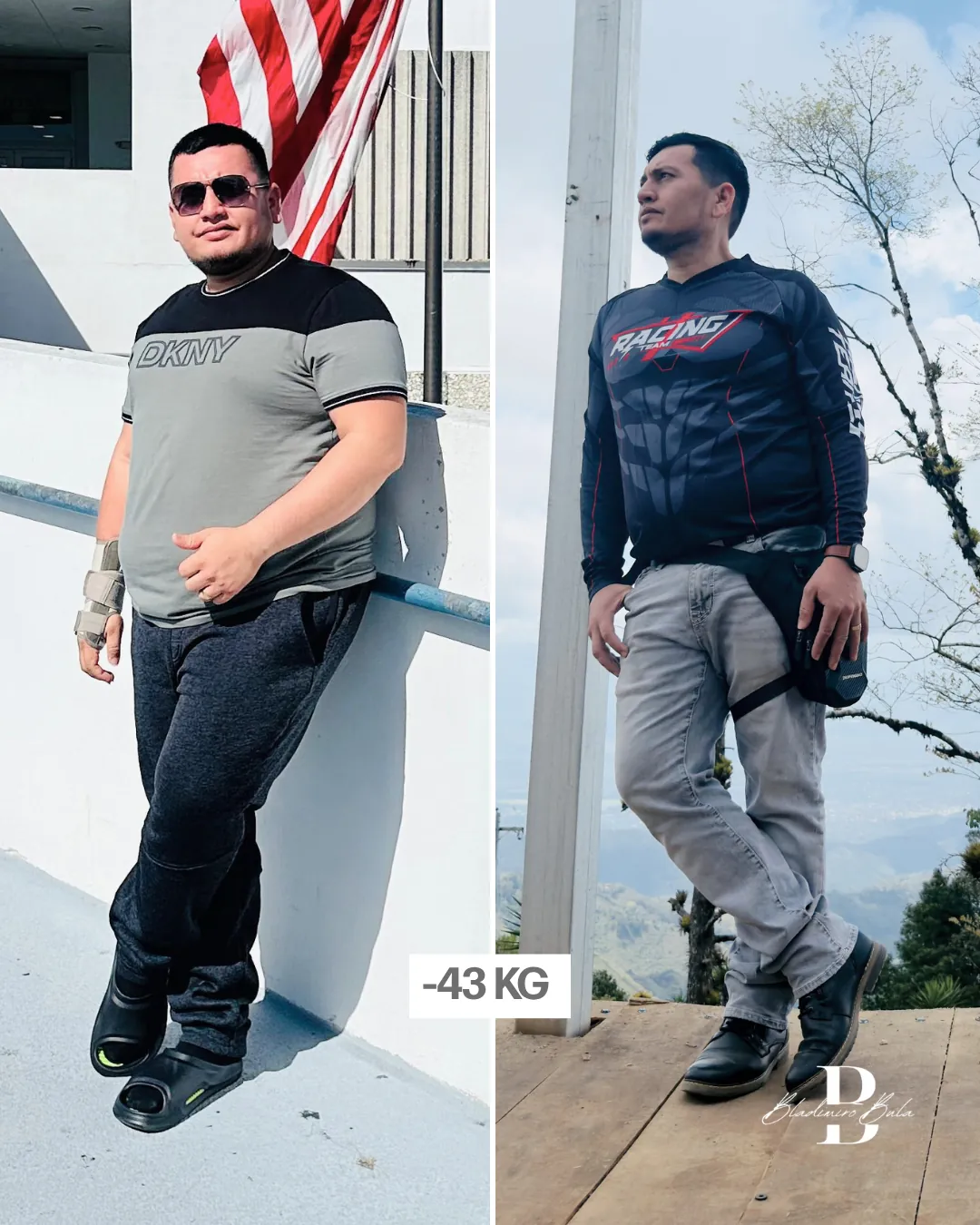 Antes y después: paciente del Dr. Bula con pérdida de 43 kg