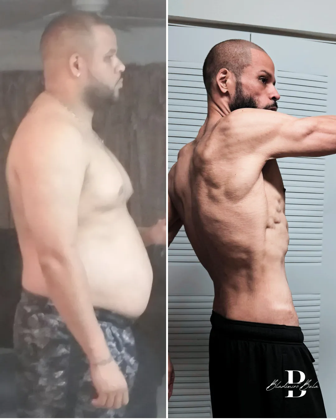 Antes y después: transformación corporal de paciente del Dr. Bula
