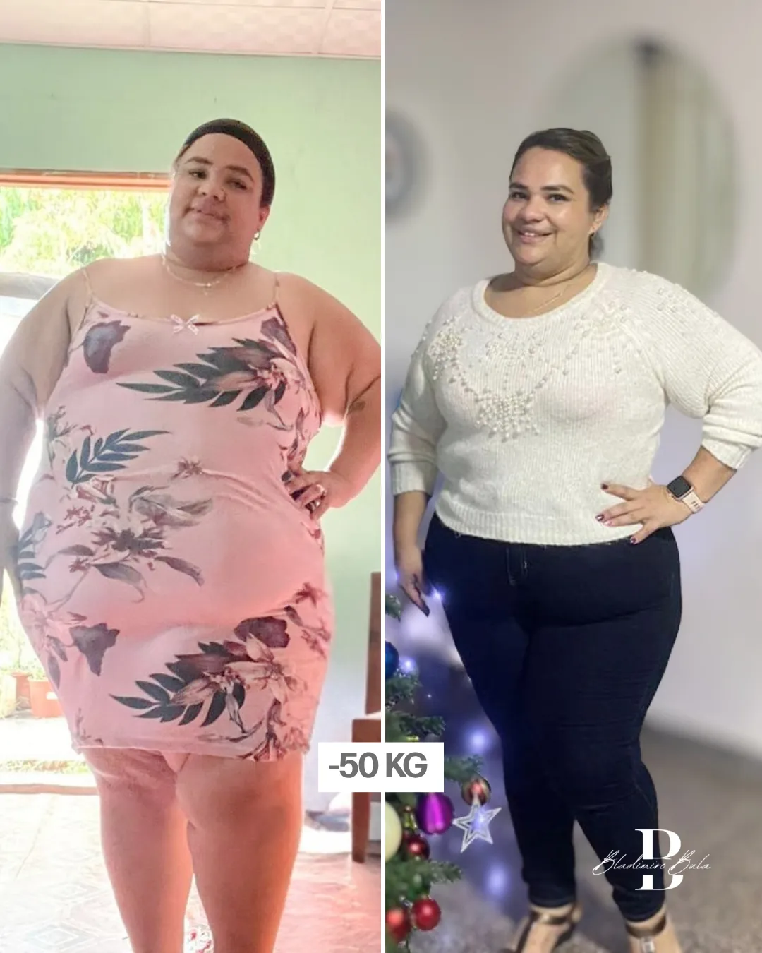 Antes y después: paciente del Dr. Bula con pérdida de 50 kg