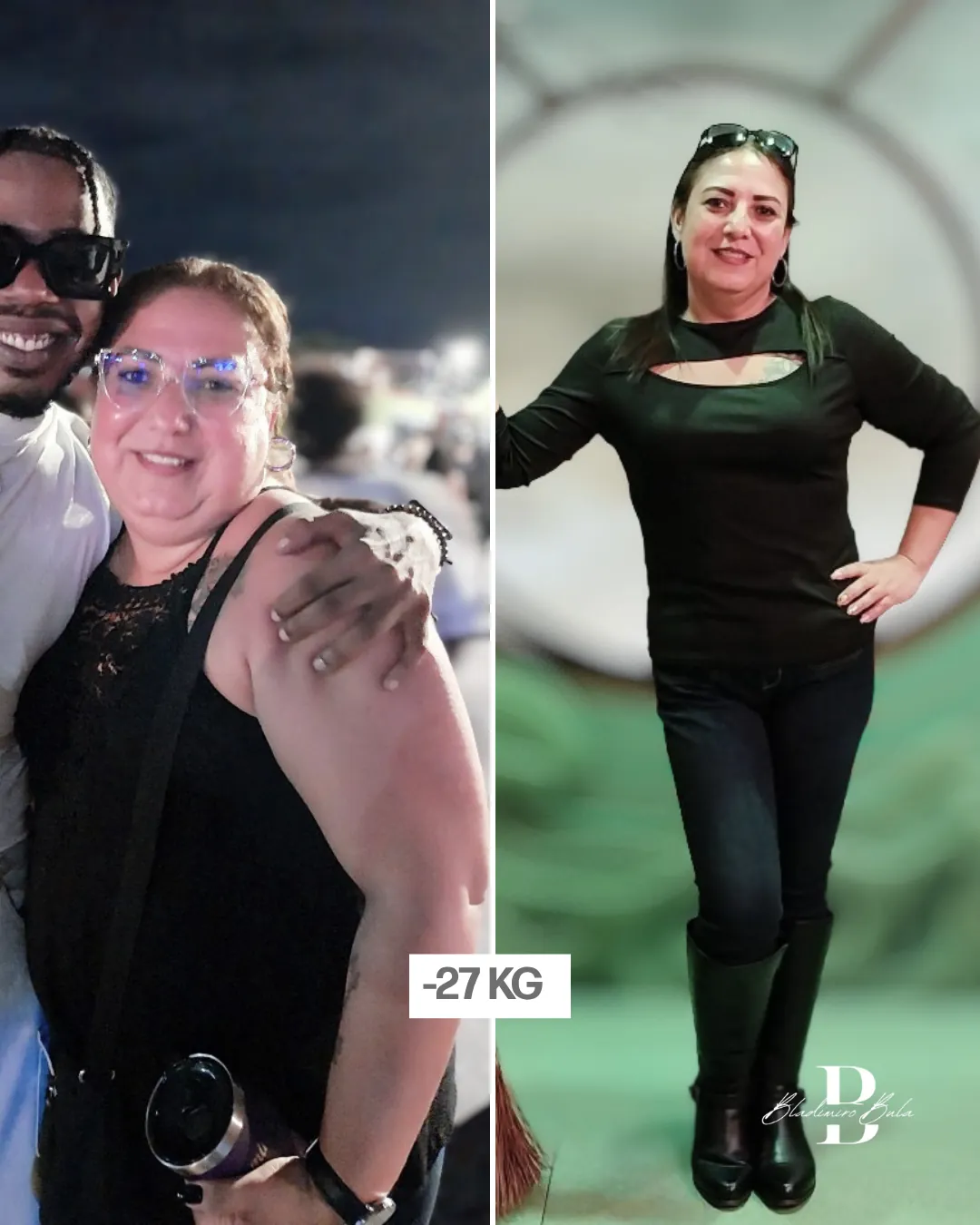 Antes y después: paciente del Dr. Bula con pérdida de 27 kg
